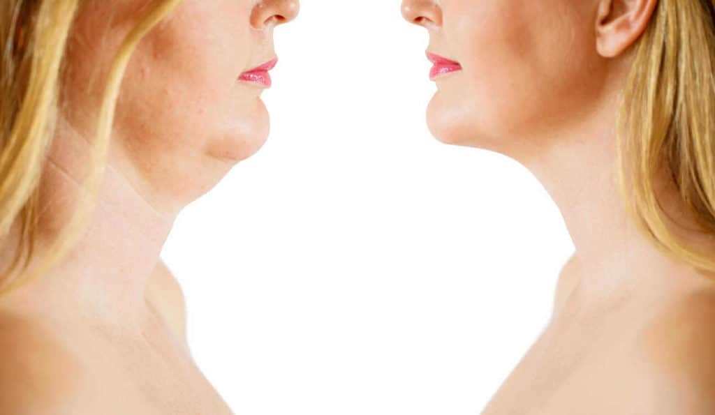 Double Chin treatment Wheathampstead before and after results