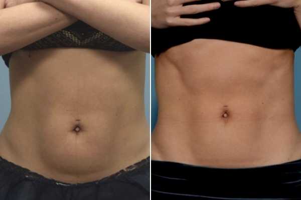 body sculpting FAQs Wheathampstead