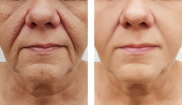 Learn more about Morpheus8 Treatment Wheathampstead today!