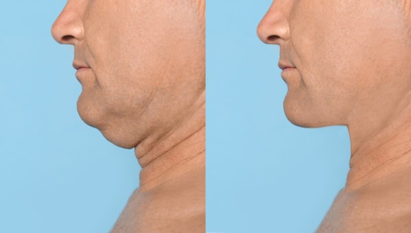 Which Non-Surgical Treatments Work Best for Jowls and Loose Skin Wheathampstead?