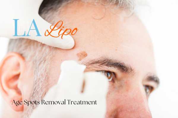 What Are the Most Effective Treatments for Age Spots Wheathampstead?