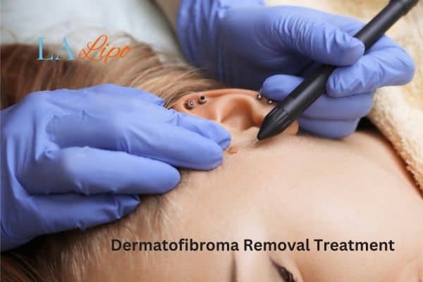 Dermatofibroma Removal Treatment Wheathampstead