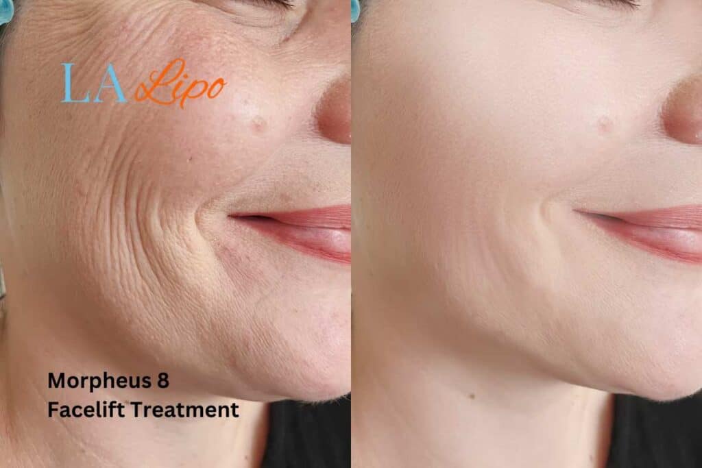 Morpheus8 Treatment Wheathampstead for flawless skin! Call us today!