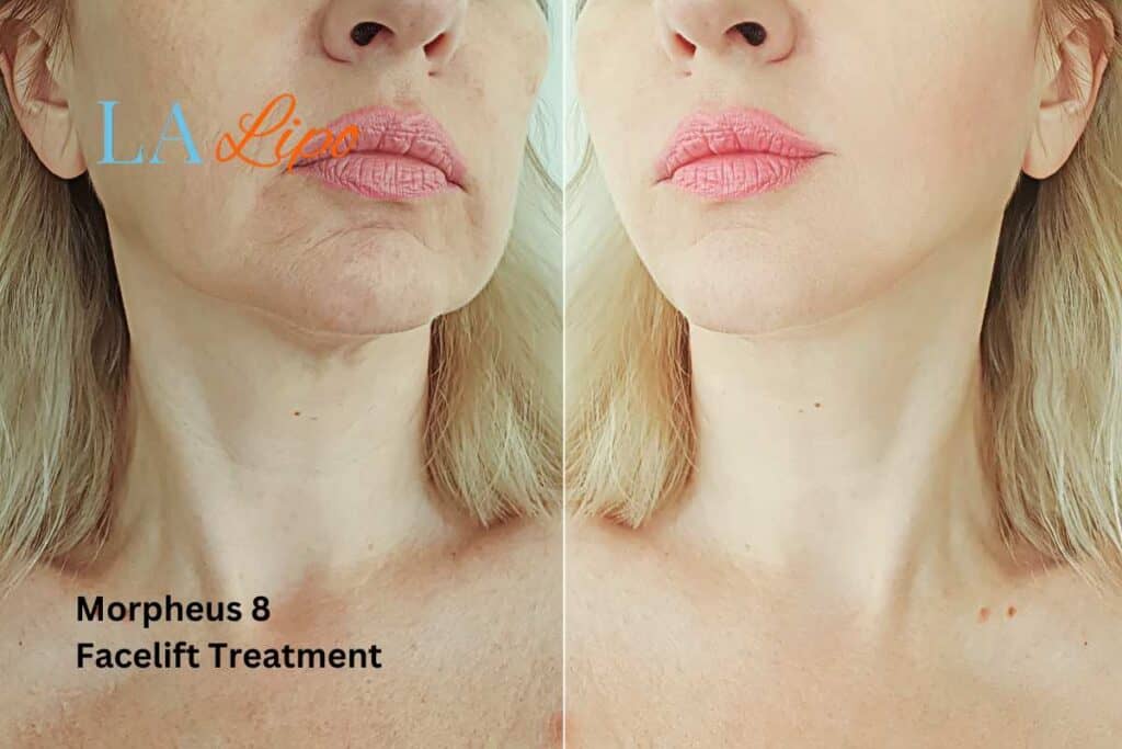 Turn back time with Morpheus8 Treatment Wheathampstead