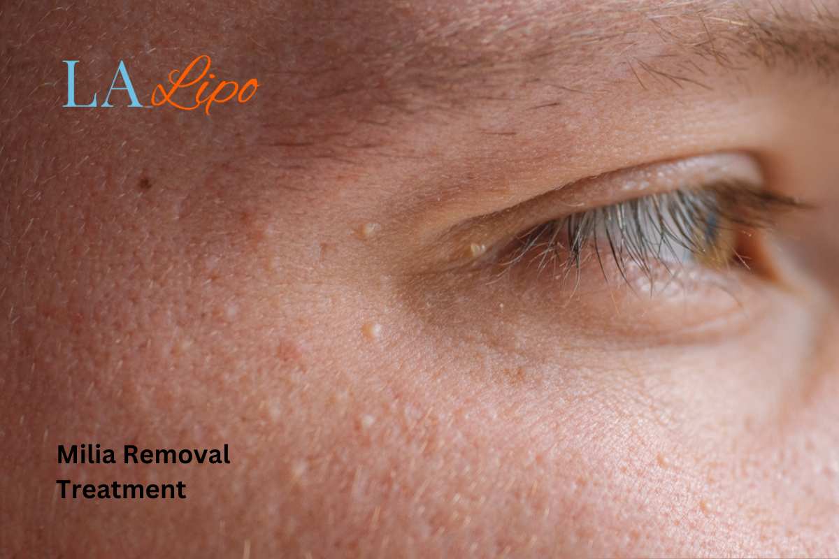 Cryopen Milia Removal: Is It the Easiest and Safest Option Wheathampstead?