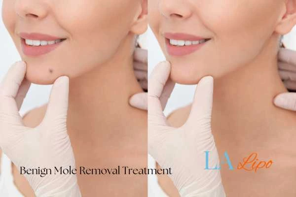 woman's before and after mole removal Wheathampstead results