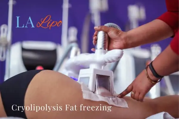 women getting fat freezing Wheathampstead
