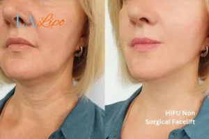hi-fu for wrinkles Wheathampstead before and after results