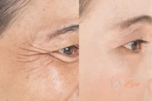 Before and after results of woman - HI-fu wrinkles reduction treatment Wheathampstead