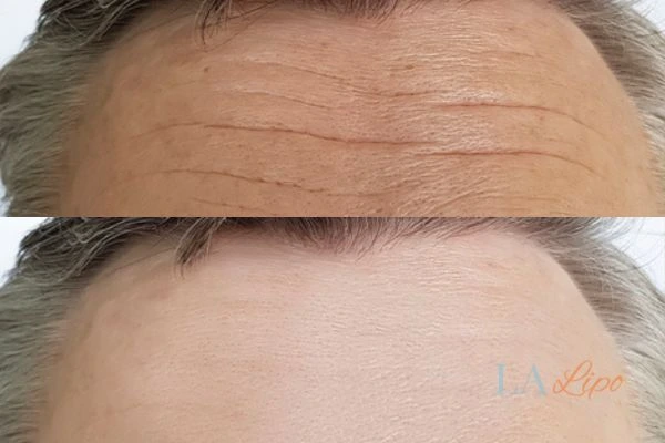 results of HIFU Wheathampstead on mans forehead to help reduce lines and wrinkles