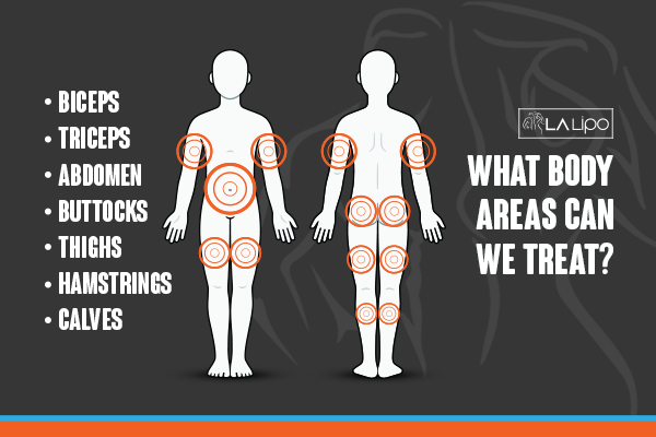 Graphic to show areas you can have LA-EMS Body Sculpting Wheathampstead treatment.
