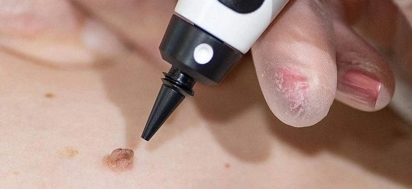 skin tag removal using cryopen Wheathampstead