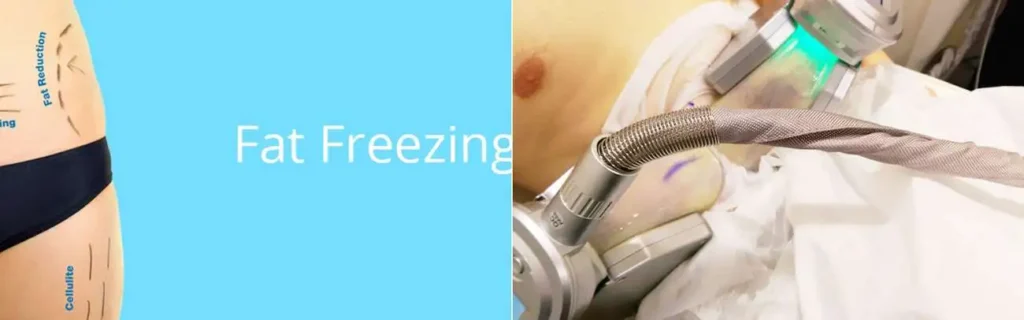 Fat freezing Wheathampstead on multiple areas of the body