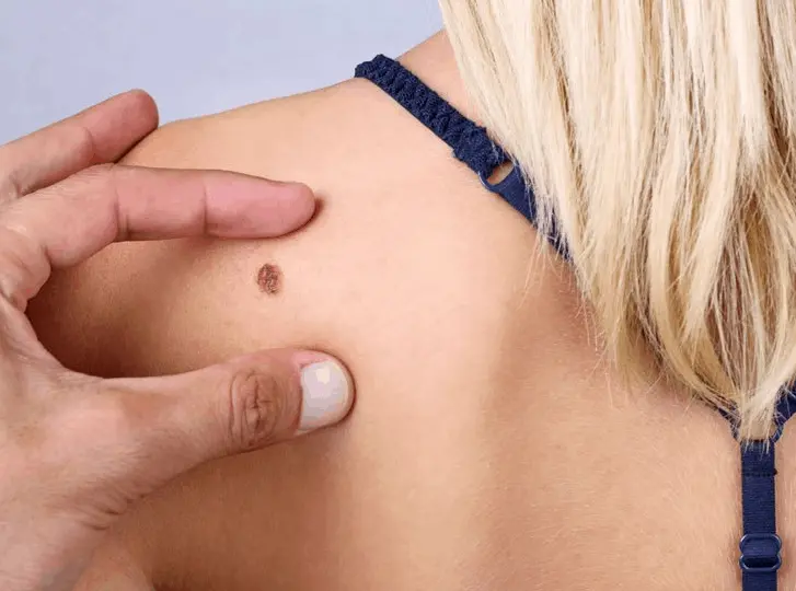 woman having mole removal Wheathampstead consultation before treatment.