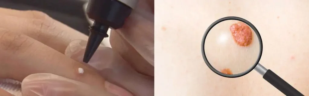 Cryopen for mole removal Wheathampstead - speak to our team today!
