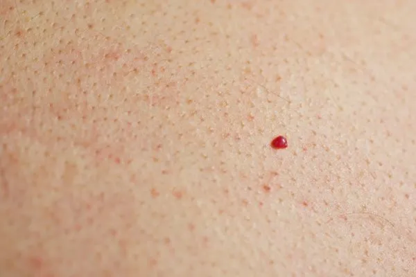 close up of a cherry angioma Wheathampstead