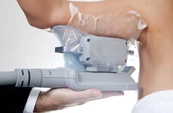 Picture of fat freezing Wheathampstead on the upper arms.