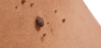 image of a skin tag Wheathampstead
