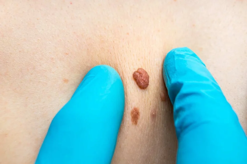 Consultant examining a skin tag Wheathampstead
