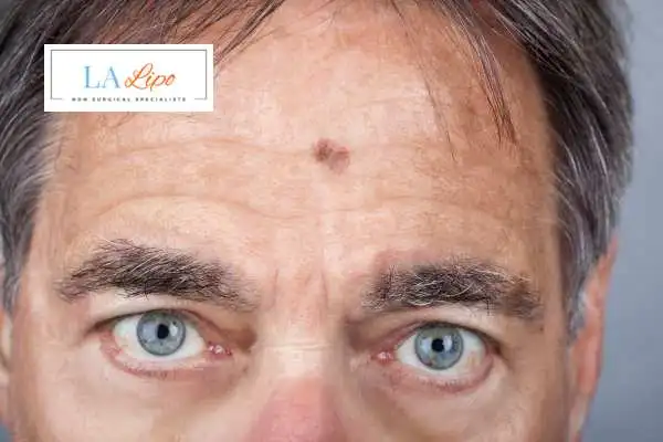 Solar Lentigo Removal Wheathampstead image of man with mark on his forehead