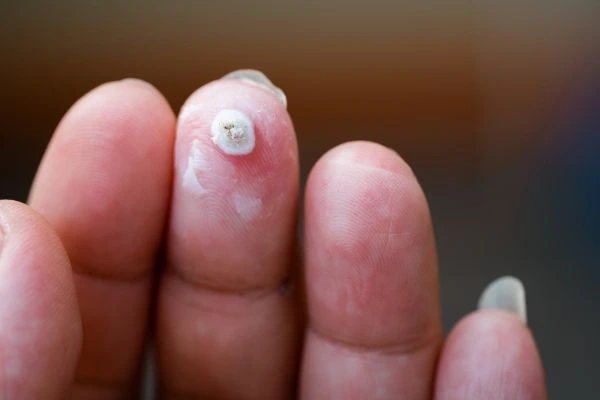 wart on person finger - cryotherapy to treat from LA LIPO Wheathampstead