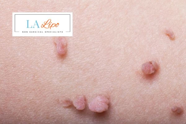 Does cryopen skin tag removal Wheathampstead hurt? Find out now call our team today!