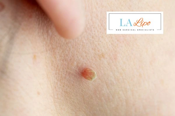 Book skin tag removal Wheathampstead today speak to our team now!