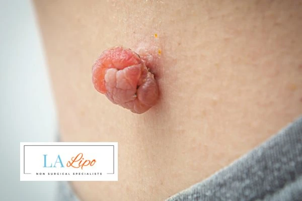 Interested in skin tag removal Wheathampstead? Concerned about the pain? Find out more today!