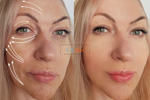 Morpheus 8 results Wheathampstead face lift.