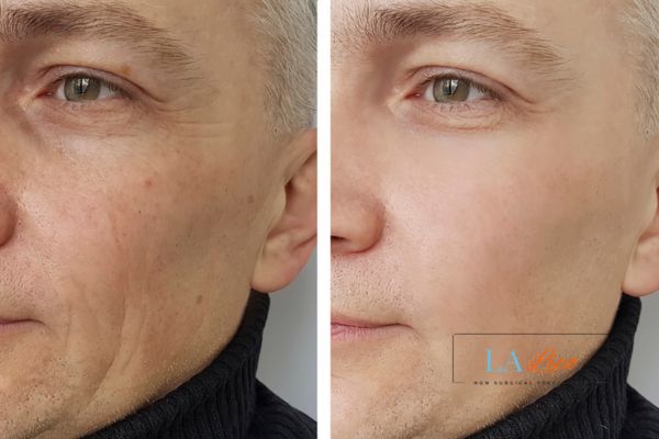 See the amazing results of Morpheus8 Treatment Wheathampstead!