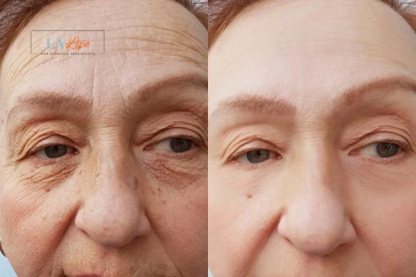 The powerful benefits of Morpheus8 Treatment Wheathampstead - Call Our team today!