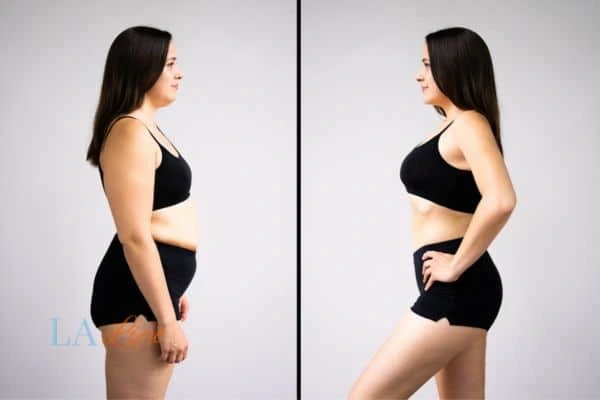 Picture of womans before and after using LA-EMS body sculpting to improve her core strength Wheathampstead