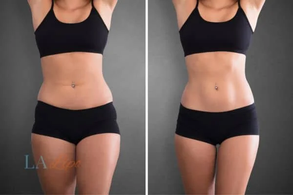 before and after results of non-surgical treatment to help a woman's body image and mental health Wheathampstead