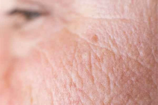 close up picture of a woman's face showing an age spot Wheathampstead