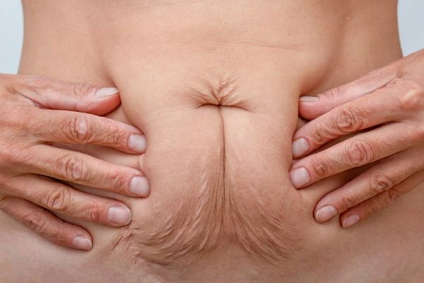 Should I Combine Diastasis Recti Treatment with Body Contouring for Better Results Wheathampstead?