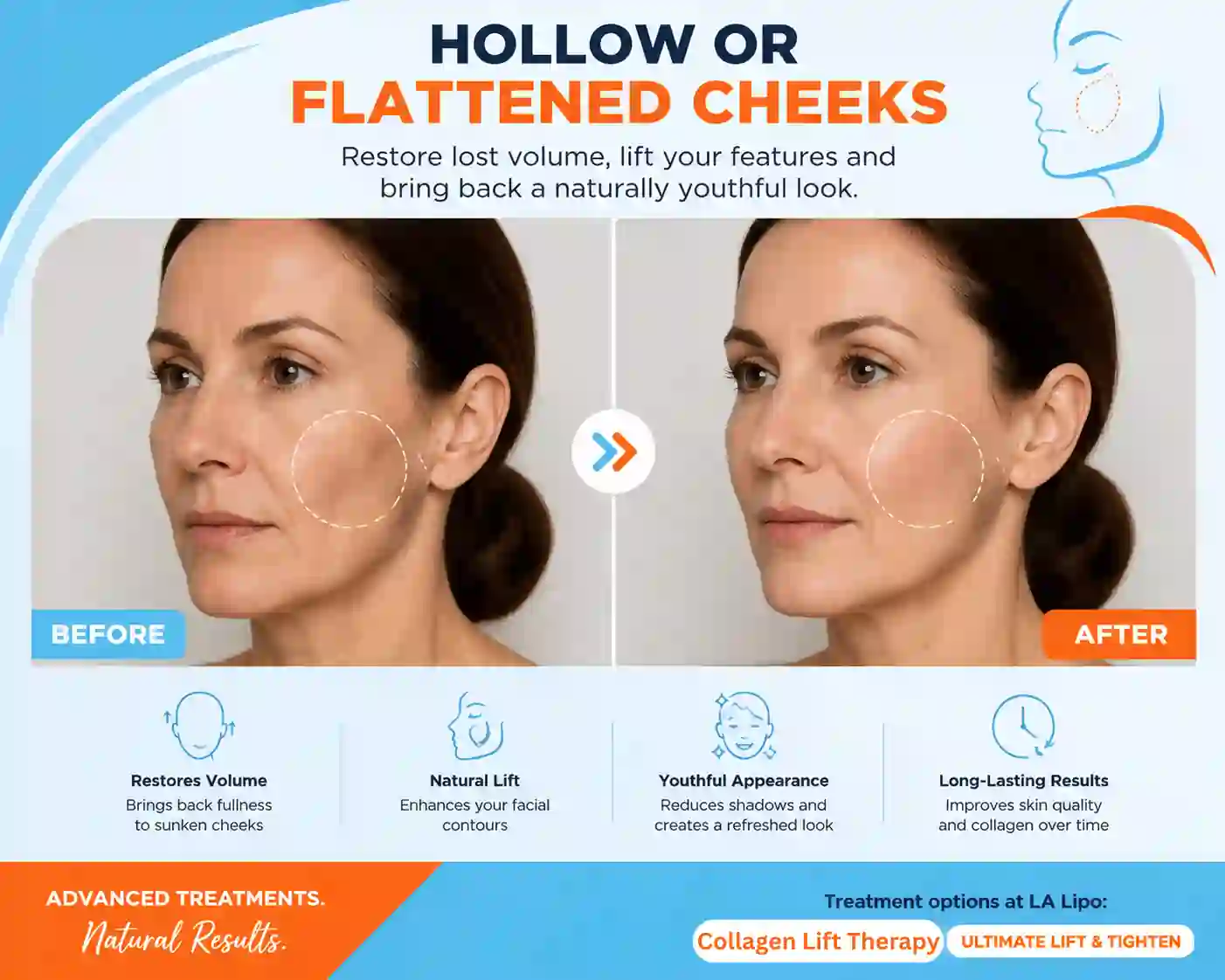 Sign #4: Hollow or Flattened Cheeks Wheathampstead