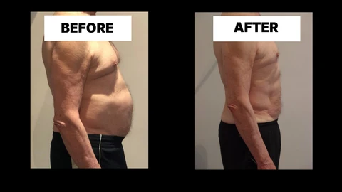 What Symptoms Can Diastasis Recti Cause in Men? Weak Core, Back Pain and Poor Posture Wheathampstead